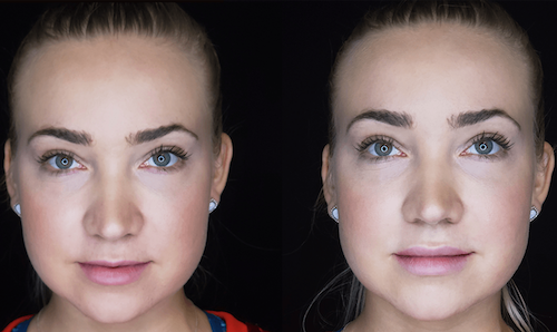 Lip Filler Subtle Enhancement Before After Oakville Lip Doctor